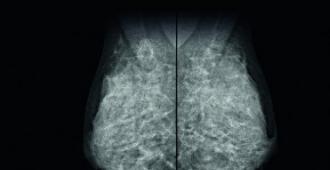 Breast Scan