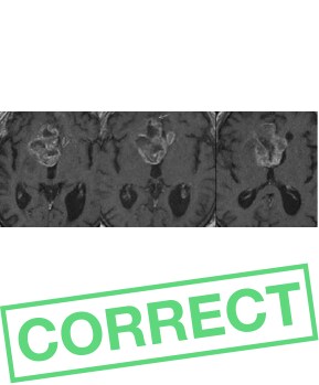 Gadovist<sup>®</sup>-enhanced brain question 2