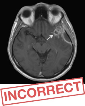Prohance<sup>®</sup>-enhanced brain question 1